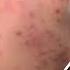 This Could Be The Itchiest Skin Condition Known To Man The Bad Skin Clinic