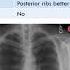 PA VIEW Vs AP VIEW CHEST X RAY