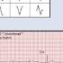 Cardiac Axis Determination