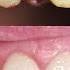 Front Tooth Crowns Before After Cosmetic Dentist Smile Makeover EMAX Preparation Remove Veneers