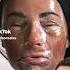 THIS IS CRAZY Extreme Phenol Peel For Acne Scarring