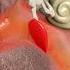 Can Holding In A Sneeze Hurt You