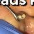 10 Years Old Ear Blackhead Removal By Dr Lalit Kasana