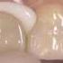 How To Use Kerr Nexus RMGI Resin Modified Glass Ionomer Cement