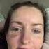 Can T Sleep Broken Skull Brain Bleed Etc But I M Happy I M Free