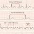 Норма и патология на ЭКГ Нарушения Ритма