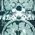 Here S How Patients Say They Reversed Early Alzheimer S Symptoms