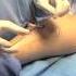 Varicose Vein Ablation UCLA Vital Signs