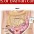 3 26 2021 Upfront Treatment Of Advanced Ovarian Cancer Ay Now The Plot Thickens