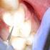 Dentist Filling A Cavity Between Teeth