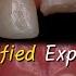 Fixing A Broken Front Tooth With A Post Core Buildup And Crown After A Root Canal