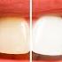 HEAL ALL Your TEETH And GUM 10000Hz 9 TEETH Healing Frequency Music