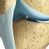 What Happens When You Tear Your ACL Acl Knee Kneepain