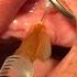 Extraction Of Canine Tooth