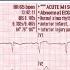 Acute Coronary Syndromes STEMI Recognition STEMI Mimics