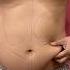 Male Abdomen Liposuction Same Day Result Ytshorts Shortsfeed