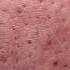 Big Cystic Acne Blackheads Extraction Blackheads Milia Whiteheads Removal Pimple Popping