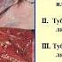 8 00 9 30 Клинико анатомические формы туберкулеза ВИЧ инфекция