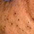 Deep Blackhead Removal By Dr Lalit Kasana Short Video Goldmine Of Blackheads