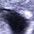 Sonogram 6 Weeks Pregnant