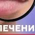 Как вылечить ГЕРПЕС навсегда Настоящие причины герпеса генитальный на губах на голове