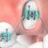 Orthodontic Treatment For Impacted Canine Laser Exposure