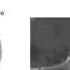 Bone Island Vs Blastic Metastasis