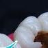 AMAZING Reconstruction Of Tooth Damaged By Caries Endodontics