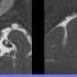 Cranial Nerve Anatomy On MRI