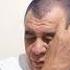 ЛЕЧЕНИЕ ГЕМОРРОЯ ПИЯВКАМИ В АНТАЛИИ ИЗ ЛИЧНОГО ОПЫТА