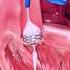 Heart Stent Aortic Valve Repair With Angioplasty Shorts Heartstent