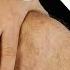 Clarke S Sign Patellar Grind Test Patellofemoral Pain Chondromalacia Patellae