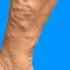 Varicose Vein Injections Watch A Vascular Surgeon Do It