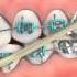 Orthodontics Treatment For Underbite Or Crossbite Rubber Bands