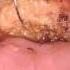 PJ Anastamosis Sans Tradenames