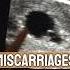 Miscarriages And Mindfulness