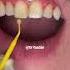 Fixing A Chipped Front Tooth Composite Bonding Cosmetic Dentist Dr Yazdan